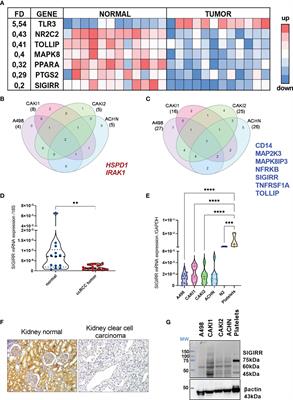 SIGIRR Downregulation and Interleukin-1 Signaling Intrinsic to Renal Cell Carcinoma